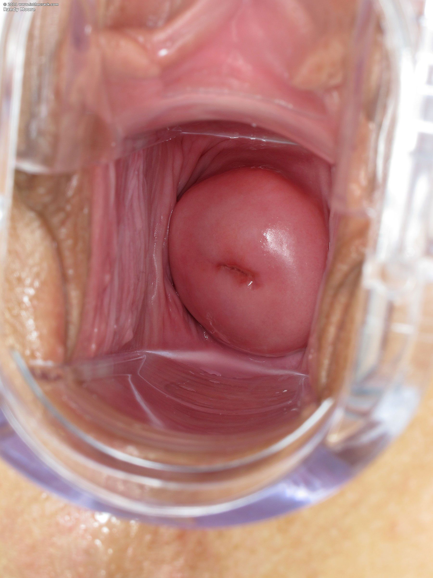 best of Close vagina cervix speculum vaginal