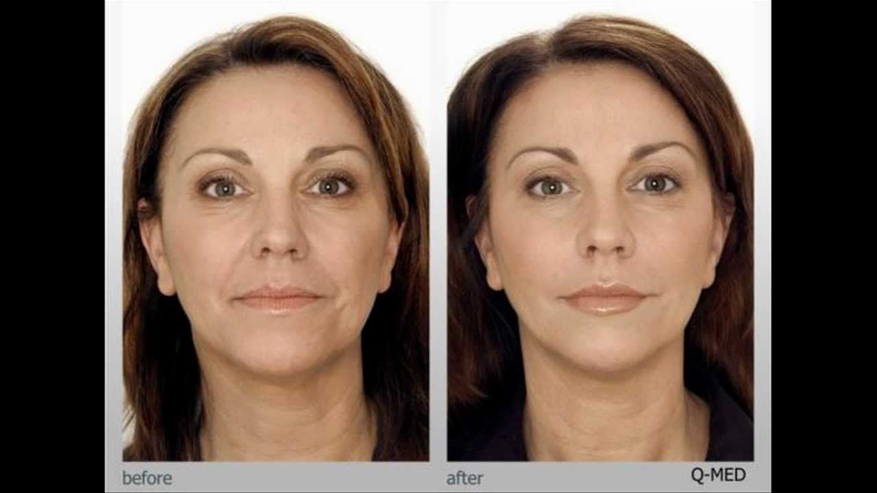California reccomend At home facial microdermabrasion