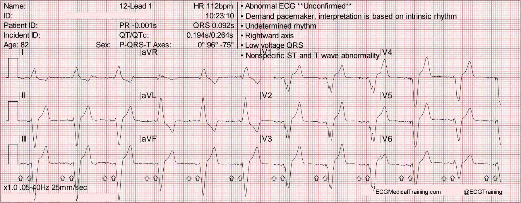 8-track reccomend Basic arrhythmia ventricular paced strip