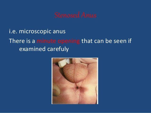 Icture of anormal anus