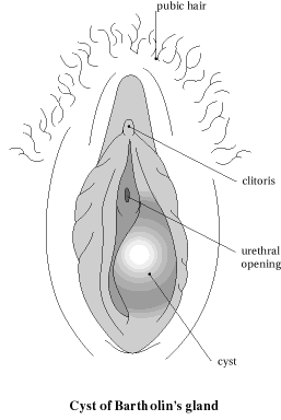 Cyst on clitoris