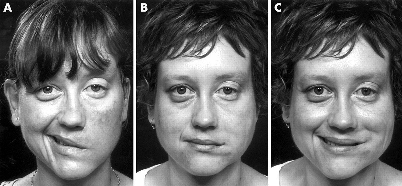 best of Surgeon plastic Facial reanimation
