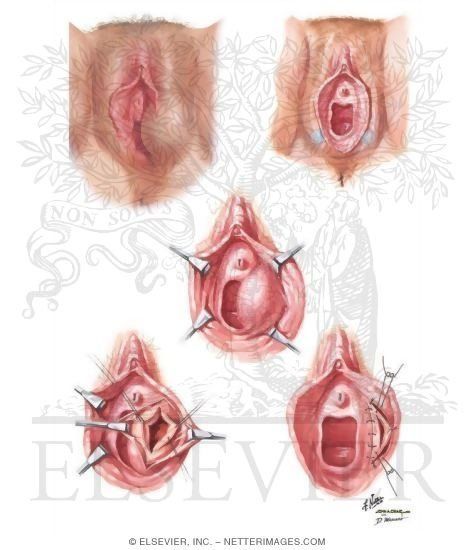 Art A. reccomend Cyst on clitoris