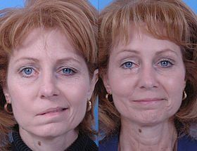 Facial reanimation plastic surgeon