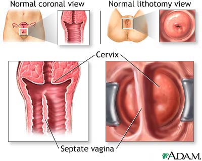Wishbone reccomend Congenital sexually women vagina
