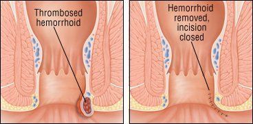 Retrograde reccomend Hard swelling in anal area