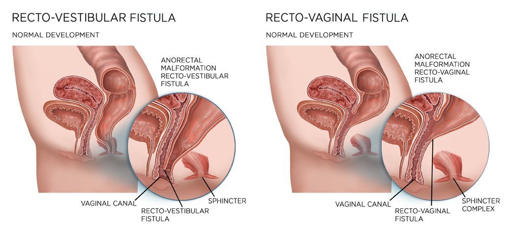 Congenital sexually women vagina