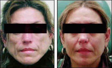Associated facial lipoatrophy