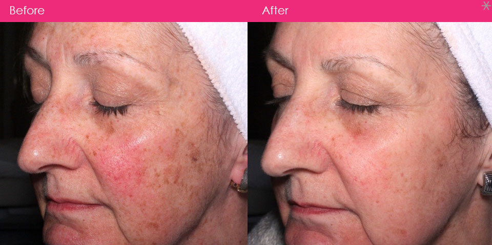 Miss reccomend Hyperpigmented skin facial