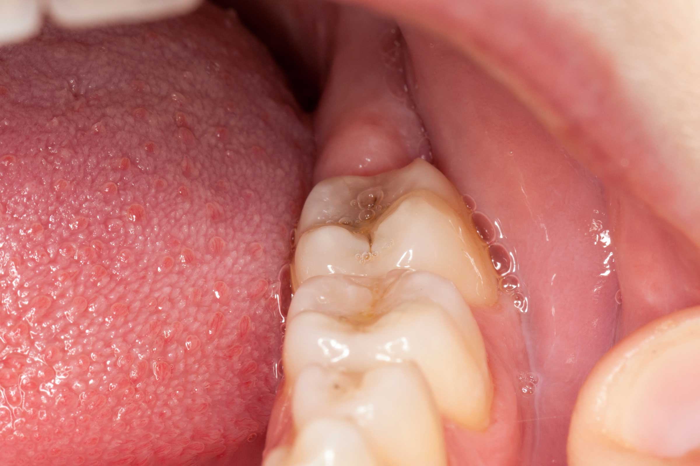QB reccomend Bottom front gums throbs periodically