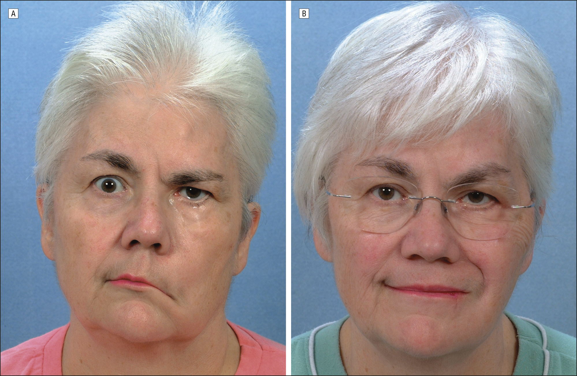 Bad M. F. reccomend Facial reanimation plastic surgeon