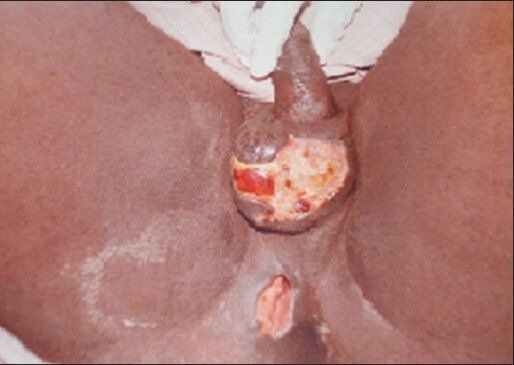 Healing of anal fistula