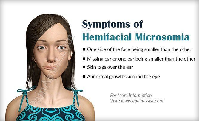 best of Facial microsomia Hemi