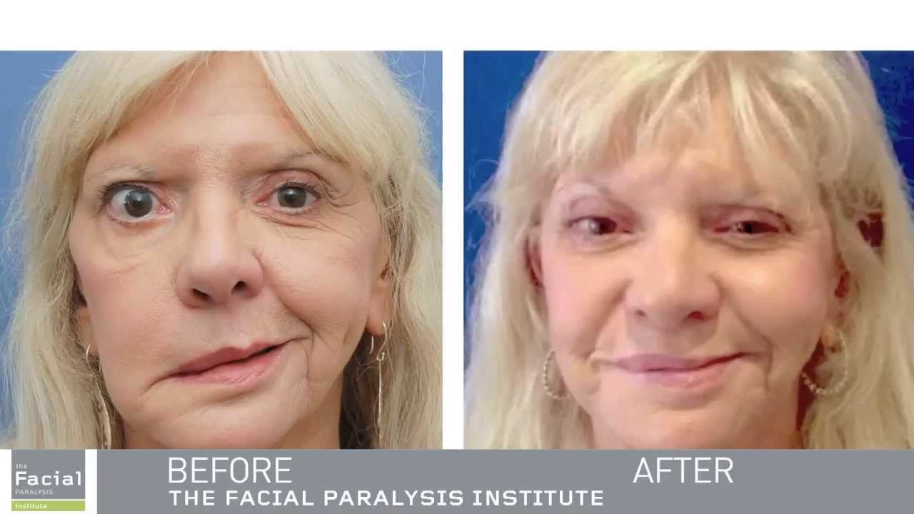 Wasp reccomend Facial reanimation plastic surgeon