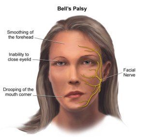 Mr. M. reccomend Multiple sclerosis facial paralysis