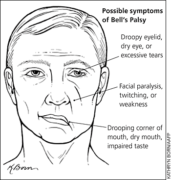 Multiple sclerosis facial paralysis