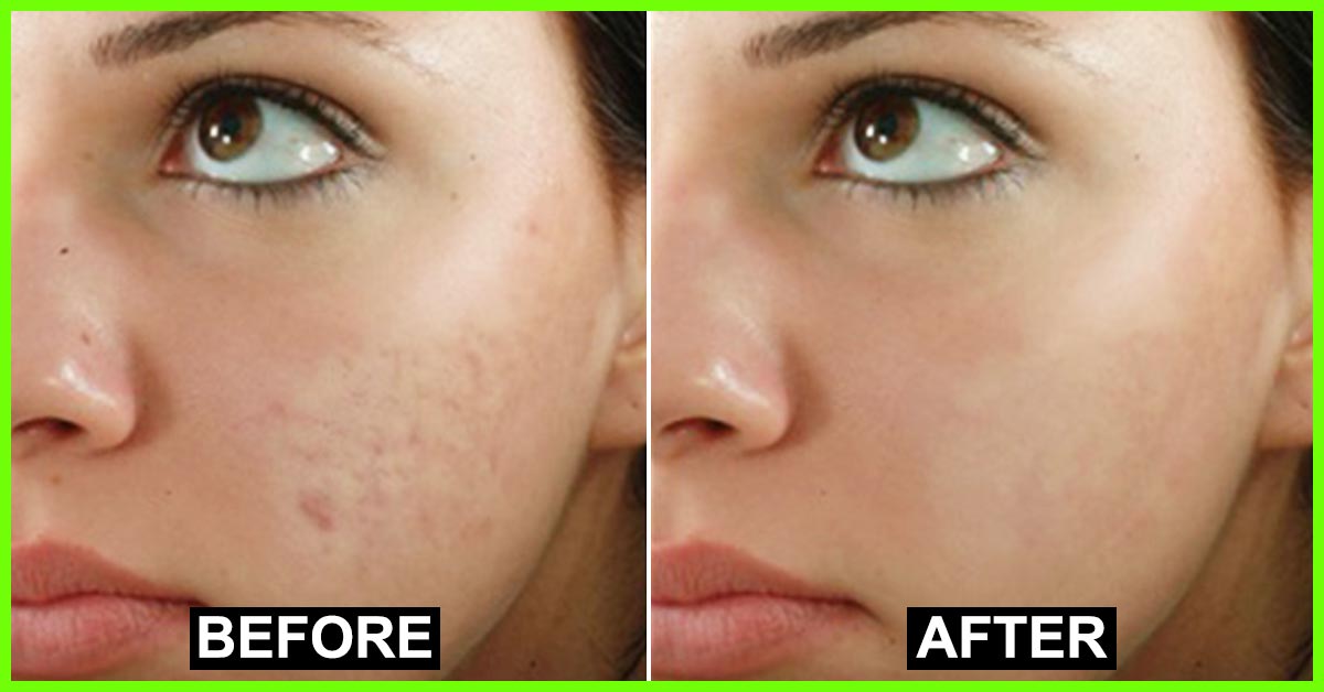 best of Spots Diminish permanently facial
