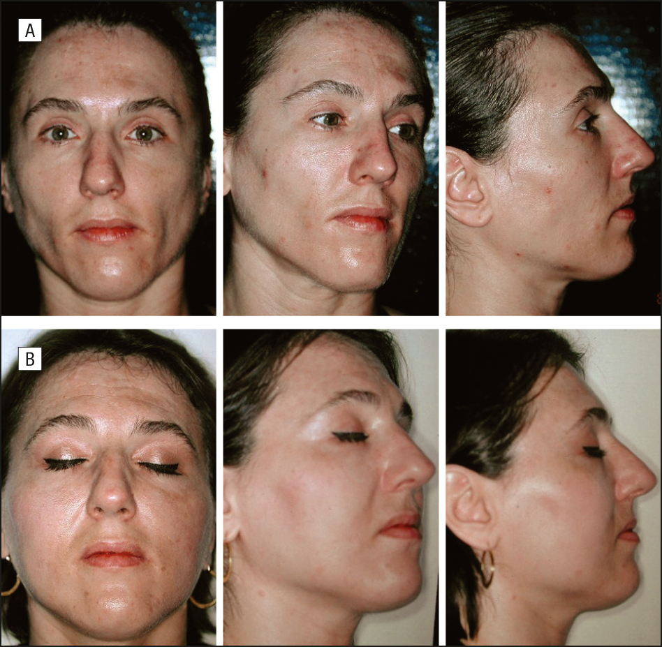 Chaos reccomend Associated facial lipoatrophy