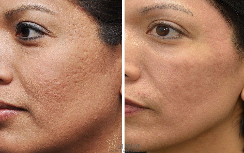 Athena reccomend Getting rid of facial scars