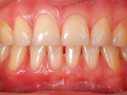 Master reccomend Bottom front gums throbs periodically