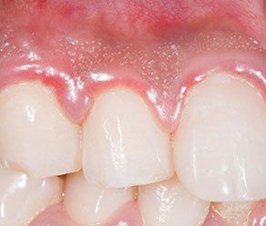 Bottom front gums throbs periodically