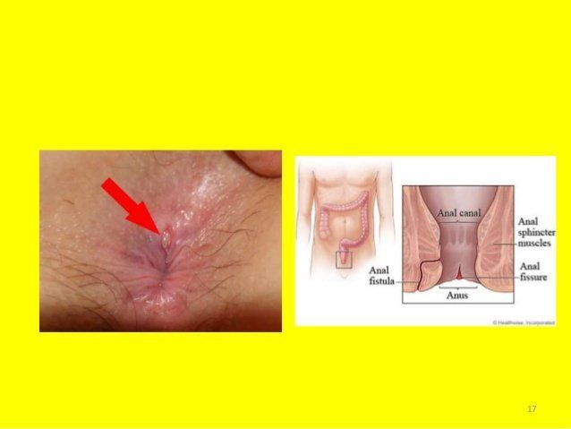 Hemorrhage of rectum and anus
