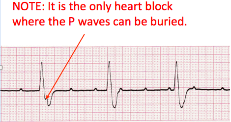 best of Ekg strip heart Cardiac