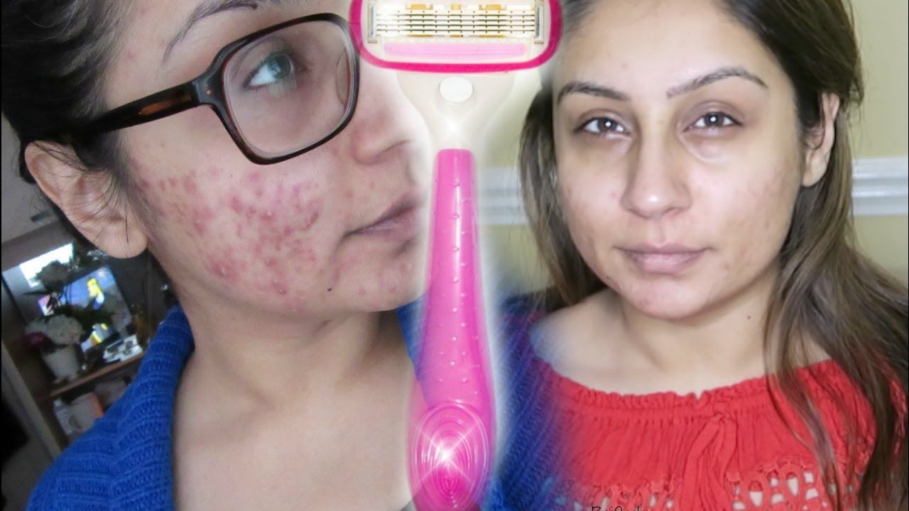 best of By caused shaving pimples Facial