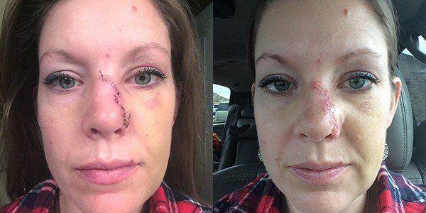 Facial stitches how long to heal