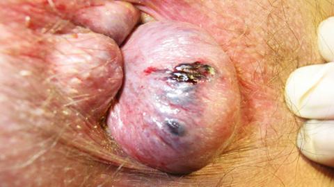 Hemorroids anal herpes