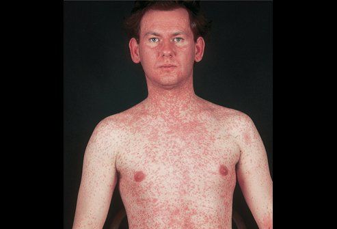 best of Of measles of Images adult onset