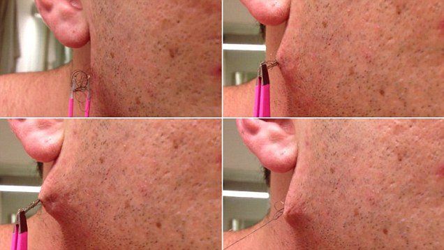 best of Facial removal Ingrown hairs