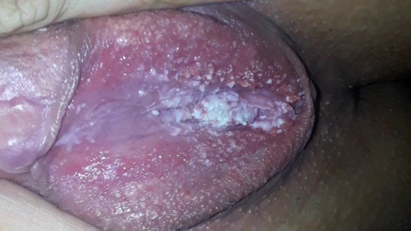 best of Bumps on vulva Itchy