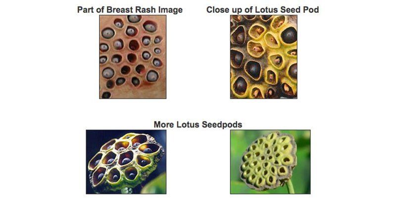 Larvae in boob