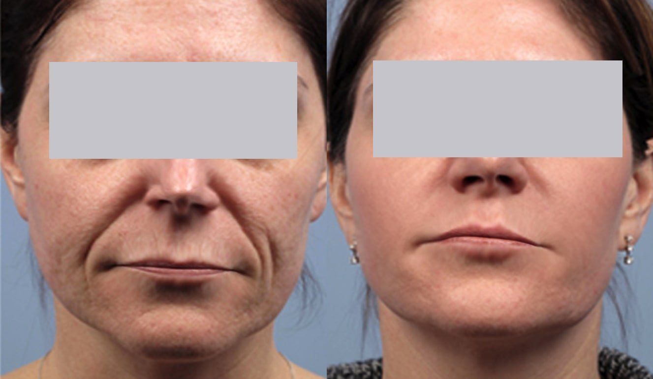 Laser foto facial non surgical face lift