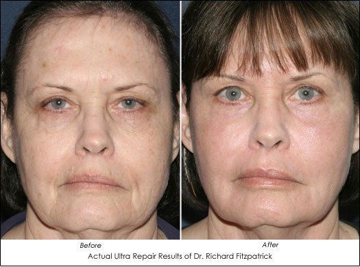 Tart reccomend Laser foto facial non surgical face lift
