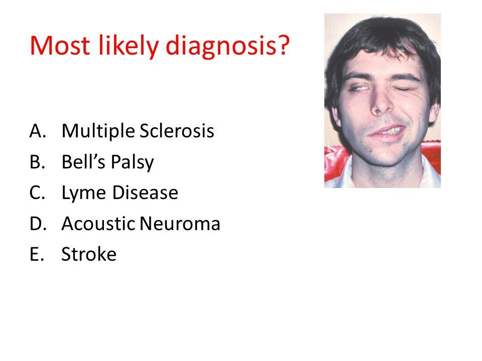 Bootleg reccomend Multiple sclerosis facial paralysis
