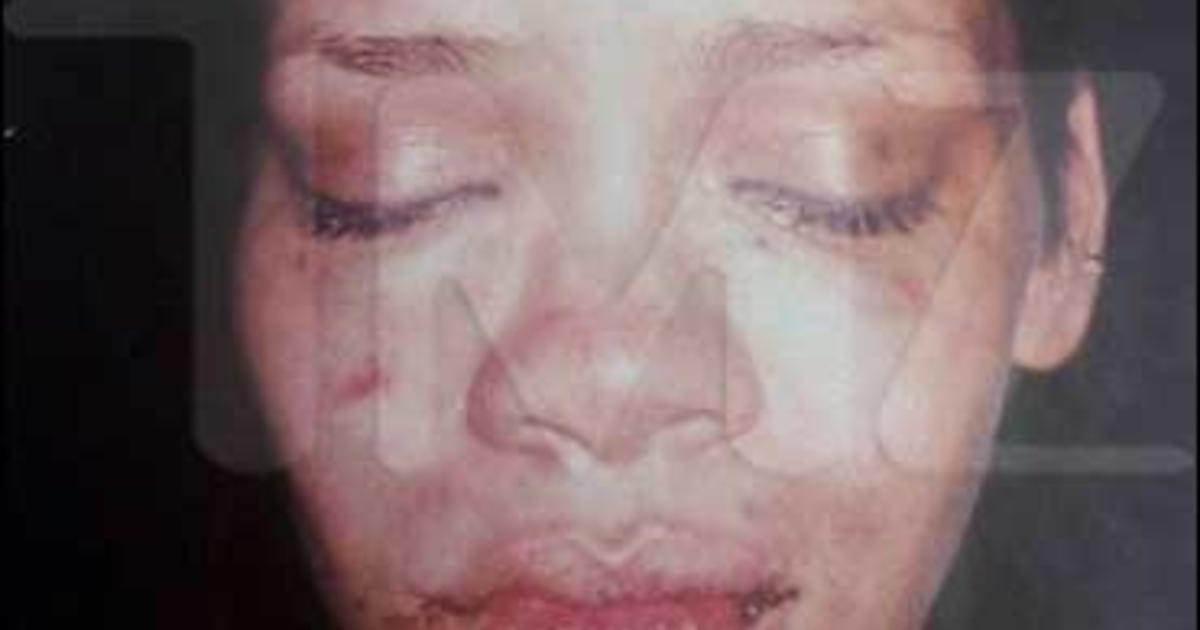 best of Injuries rihannas Pictures of facial