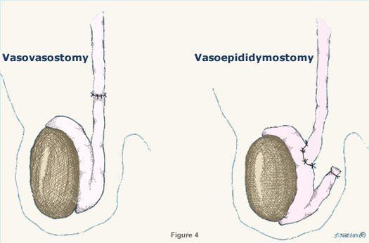 best of After for Sperm removal vasectomy pregnancy