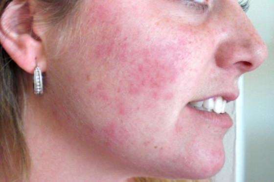 best of Facial pictures find skin rashes i of can Where